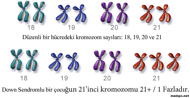 trizomi 21