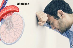 Epididimit