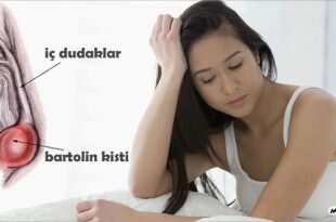 bartolin kisti