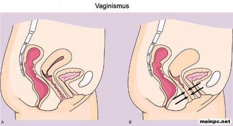 vaginismus