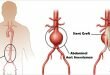 Abdominal Aort Anevrizması