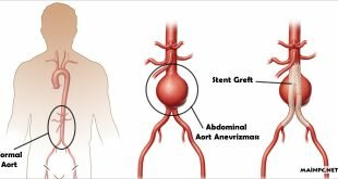 Abdominal Aort Anevrizması