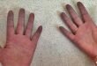 Raynaud Fenomeni
