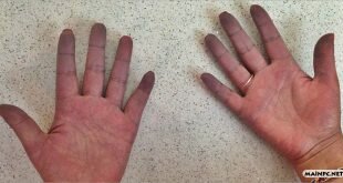 Raynaud Fenomeni