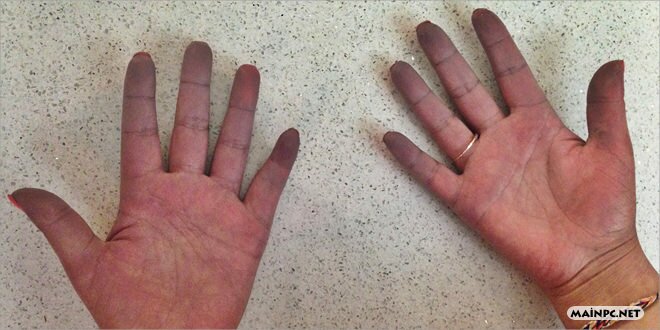 Raynaud Fenomeni
