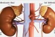 Adrenal Tümör (Kanser)