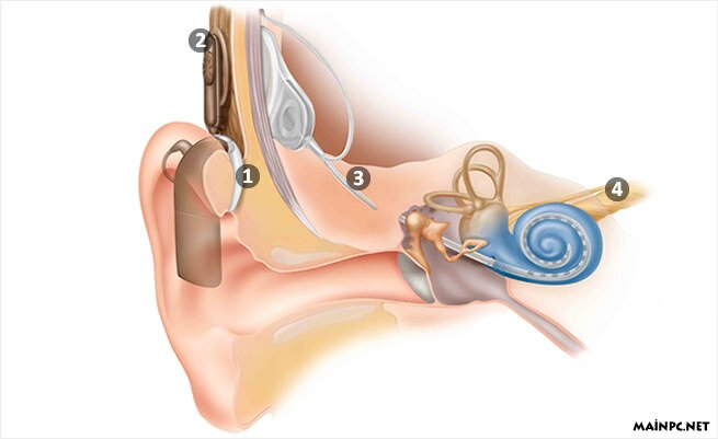cochlear implant