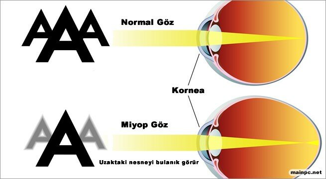 miyop-nedir